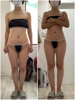 プラチナアース 守谷店(Platinum earth)/痩身ビフォーアフター