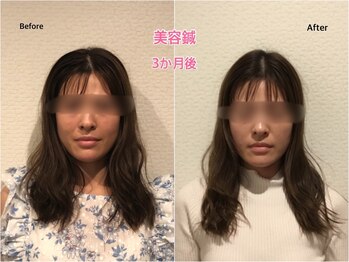 チキバン美容鍼灸整体サロン 心斎橋店/美容鍼（美容針）