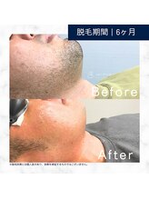 メンズクリア 高知帯屋町店/【メンズクリア】お客様の施術例