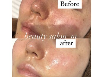 エム(M)/シミケアもニキビケアも毛穴も