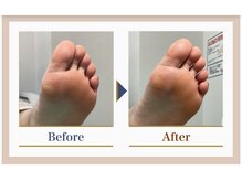 巻き爪補正店 錦糸町店/【タコ・魚の目ケア】