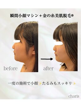 カリス(charis)/お顔の脂肪撃退！