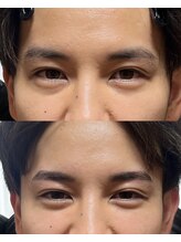 アルデオンワン セカンド(ARDEON.1 second)/【メンズ眉毛】Before/after