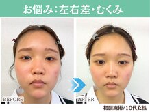 ナチュラルビューティーフェイス 横浜(NBF)/むくみ・左右差 / 10代