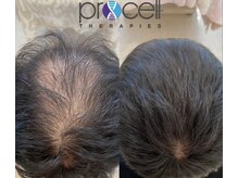 頭皮の再生で髪の毛にボリュームを！