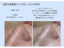 ビオルブ(VIOLVE)/毛穴洗浄/ハーブピーリング/徳島