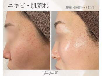 スリースリー(THREE THREE)/ニキビ・肌荒れ