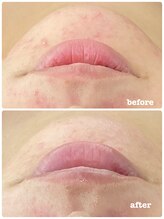 ピアーノ(PIANO)/エルモサハーブピーリング