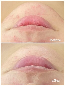 ピアーノ(PIANO)/エルモサハーブピーリング