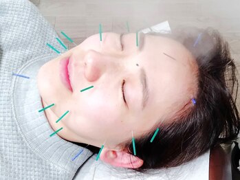 ほぐしてコリとる/ブライダルボディケアに美容鍼