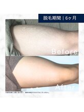 メンズクリア 高知帯屋町店/【メンズクリア】お客様の施術例