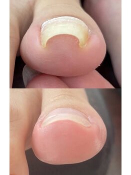 エージェーネイルズ(AJ Nails)の写真/*口コミ高評価*【巻き爪補正 親指1ヶ所￥12800】辛い悩みご相談下さい!足元のケアもできるサロン[麻布十番]