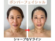 コトハ(cottha)/1回施術後