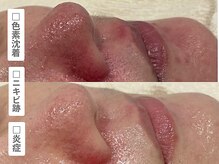 アンシャンテ 神戸元町店(Enchante)/毛穴洗浄ピーリングフェイシャル