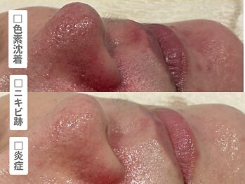 アンシャンテ 神戸元町店(Enchante)/毛穴洗浄ピーリングフェイシャル