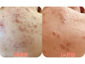 クイーン(QUEEN)/光フォトのビフォーアフター