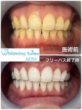 アエラ(AERA)/【効果の高いホワイトニング】