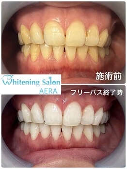 アエラ(AERA)/【効果の高いホワイトニング】