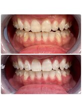 エクシアホワイトニング 日本橋店/ビフォアフ！