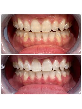 エクシアホワイトニング 日本橋店/ビフォアフ!