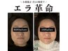 【エラ/むくみ/食いしばり改善】小顔頭蓋骨矯正+高濃度酸素オイル¥12,100→