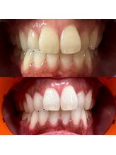 フフフ(Fff)/本格派セルフホワイトニング☆