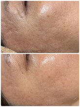 サロン ド エン(Salon de. en)/敏感肌ケア◇ハーブピーリング