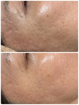 サロン ド エン(Salon de. en)/敏感肌ケア◇ハーブピーリング