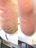 角質ケアコース☆既存コースで物足りない方に☆タコ・魚の目・踵ケア（60分）