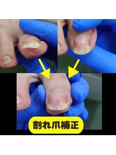 どうはく堂 西勝山接骨院/割れ爪補正