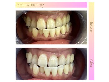 エクシアホワイト 広島袋町店/ホワイトニングビフォーアフター
