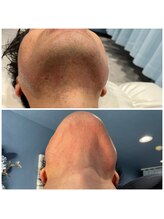 バロン/ヒゲ脱毛