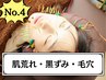たるみ＆毛穴◎美容鍼＋ハーブピーリング　¥14000→¥7980
