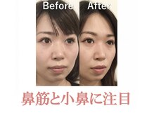 ラプリ 梅田店(Raplit)の雰囲気（スッキリとした小鼻に☆梅田/小顔/小顔矯正）