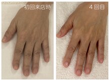 キレイテ 上野店/30代/4回目【ハンドケア稲荷町】