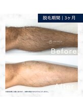 メンズクリア 高知帯屋町店/【メンズクリア】お客様の施術例