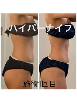 ルヴェール 久屋公園(le verre)/ハイパーナイフ全身