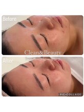 クリーンアンドビューティ 札幌(Clean&Beauty)/ダウンタイムなしの韓国産イロン