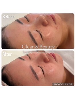 クリーンアンドビューティ 札幌(Clean&Beauty)/ダウンタイムなしの韓国産イロン