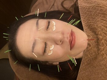 リノア鍼灸院(LINOA)/目の下だる~ん