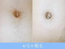 オーシャンブルー 大分店(OCEAN BLUE)/お腹脱毛