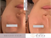 シエスタ(siesta)/セルマン艶玉肌トリートメント