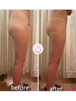 アリビオ(ALIVIO。)/【ヒップアップ】★30代症例★