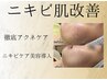 【荒れた肌を速攻鎮静】高濃度ニキビケア美容液で肌トラブルを根本から改善！