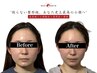【削らない整形級。あなた史上最高の小顔へ】美容鍼×小顔矯正×高周波×整体