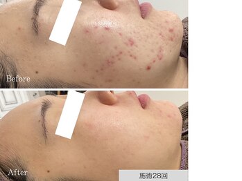 ニキビ研究所 千葉店/肌に合わせて施術を変えます！