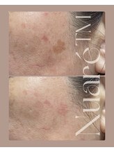 エスビーエス オキナワ(SBS OKINAWA)/シミケアモニター様