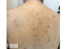 ピリナ 名古屋/【背中ハーブピーリング】症例