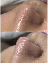 ティーツリー 名古屋 桜山(Tea Tree)/徹底的に黒ずみ角栓除去1