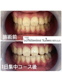 ホワイトニングサロン 京都烏丸店/４回照射後